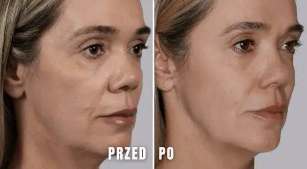 Porównanie skóry kobiety przed i po zabiegu kosmetycznym.